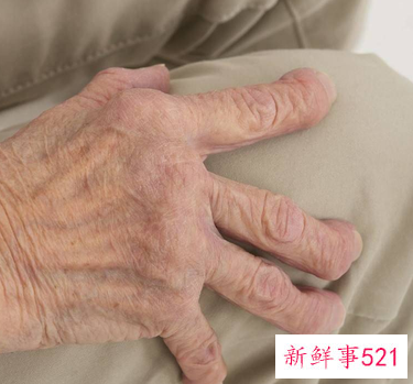 天热手肿胀天凉又没事