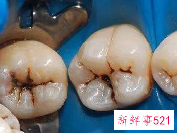 牙齿变成蛀牙的过程是怎样的