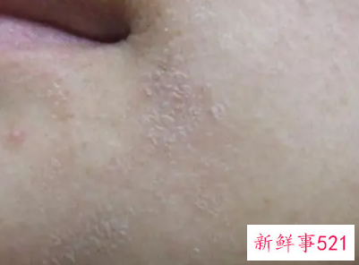 冬季脸干起皮起痘怎么办