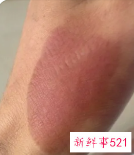 烫伤怎么处理好的更快