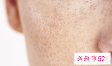 怎么把皮肤底层黑色素排出来