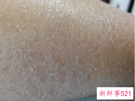 孕妇身上皮肤干燥脱皮起屑擦什么