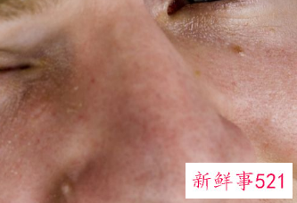 黄褐斑变好的迹象