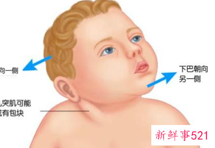 怎么判断宝宝斜颈