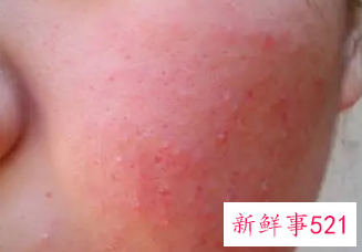 冬季脸部过敏了怎么办