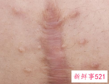 脸上有疤痕如何消除