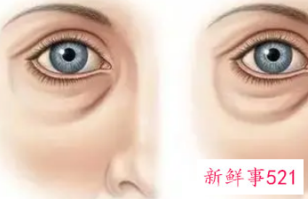 自体脂肪填充泪沟能保持几年