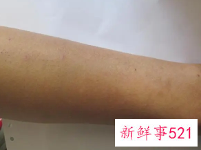 日光性皮炎最严重的后果