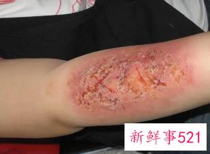 已婚女人梦见自己受伤了