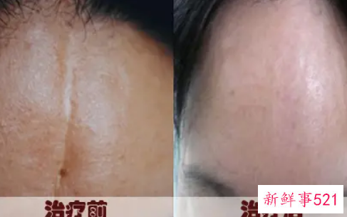 脸上有疤痕如何消除