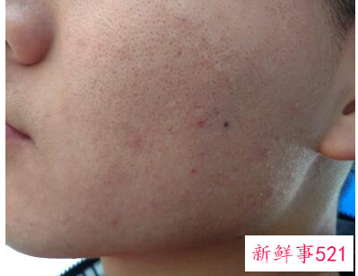 油性皮肤如何保持清爽