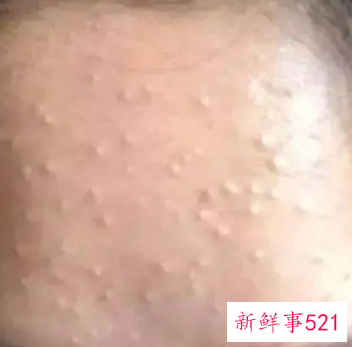 粉刺闭口是什么原因长出来的