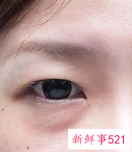 有什么消除眼袋的方法