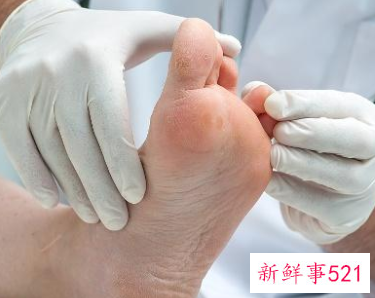 脚气气味重怎么治疗