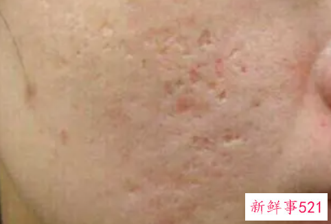 痘印怎么消除