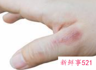 烫伤怎么处理好的更快