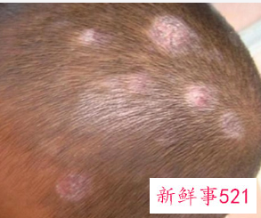 梦见头癣有什么征兆