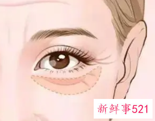 日常哪些方法能祛眼袋