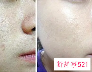 光子 嫩肤能维持多久