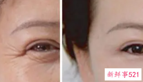 国内最好的除皱方法