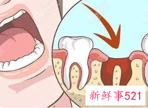 拔牙后怎么知道感染了