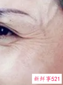 消除眼部皱纹哪效果好