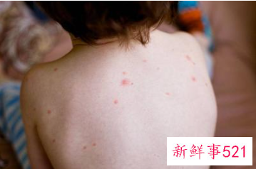 去痱子的最快方法