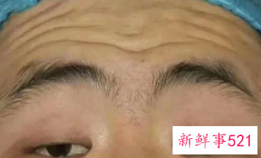 怎样快速消除抬头纹