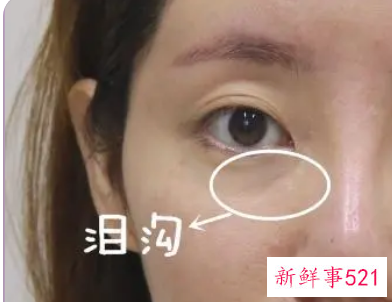 自体脂肪填充泪沟能保持几年