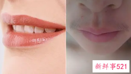 嘴唇上面胡子怎么处理比较好