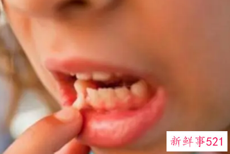 梦见下面的牙齿掉了