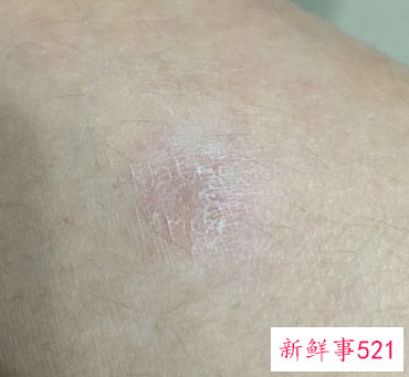 孕妇身上皮肤干燥脱皮起屑擦什么