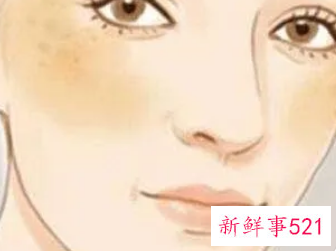黄褐斑变好的迹象