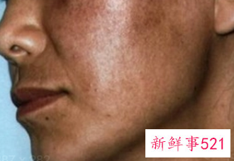 黄褐斑变好的迹象