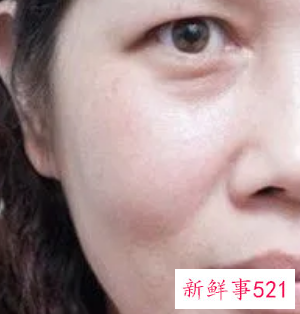 自体脂肪填充泪沟能保持几年