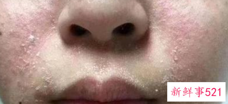 冬季脸干起皮起痘怎么办