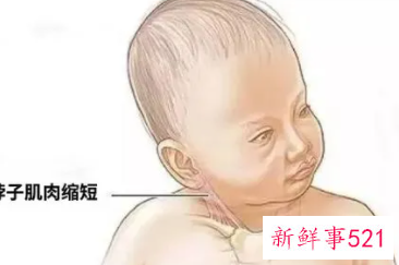 怎么判断宝宝斜颈