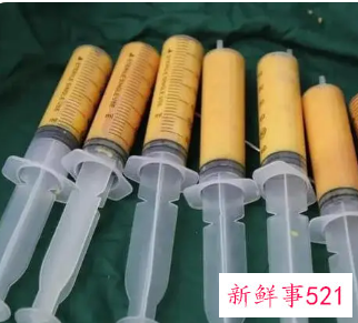 自体脂肪填充泪沟能保持几年