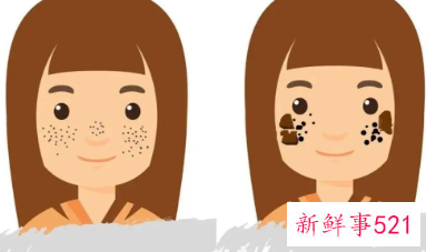 脸上长老年斑怎么去掉