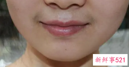 嘴唇上面胡子怎么处理比较好