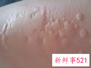 春季皮肤痒是怎么回事