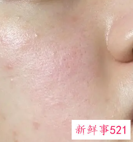 皮肤屏障受损症状