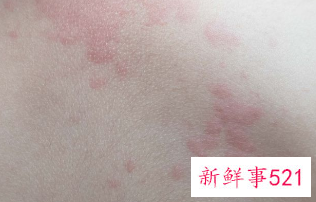 春季皮肤痒是怎么回事