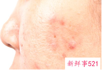 脸颊两边长痘痘怎么改善