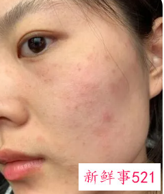 皮肤屏障受损症状