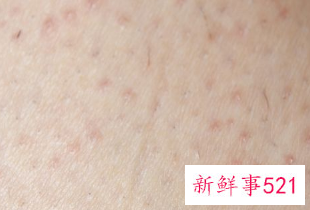 春季皮肤痒是怎么回事