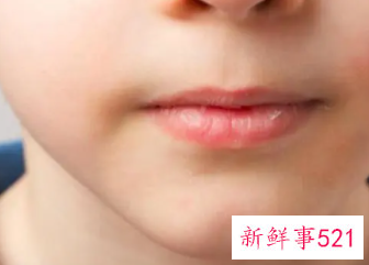 嘴角脱皮擦什么药