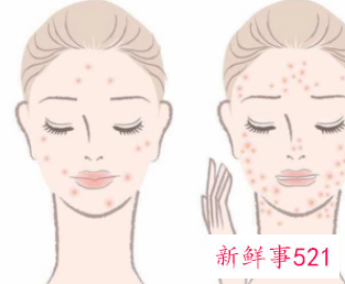 水油不平衡是怎么引起的