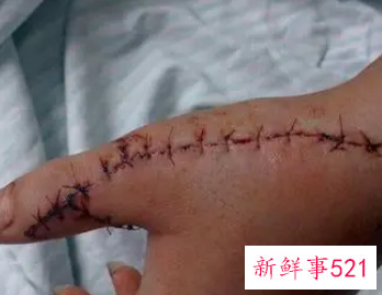 梦见伤疤有什么征兆