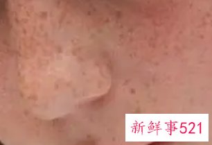 小女孩脸上有斑点是怎么回事